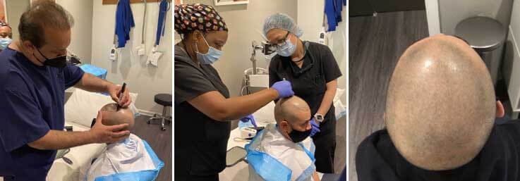 FUE hair transplant procedure